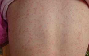Paternit Oggi - Malattie infettive: la Scarlattina, malattia infettiva e batterica