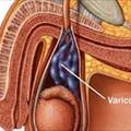 Il varicocele Che cos', come si scopre e come si cura