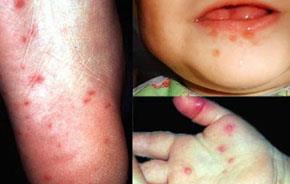 Paternità Oggi - malattie infettive: malattia mano-piede-bocca