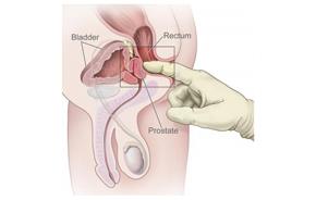 Paternità Oggi - Tumore alla prostata: dubbi sul test PSA per la prevenzione del tumore