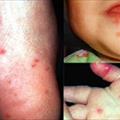 malattie infettive: malattia mano-piede-bocca