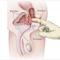 Tumore alla prostata: dubbi sul test PSA per la prevenzione del tumore